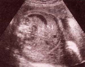 Abdomen Fetal, Imágenes intestinales y cólicas