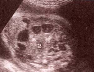 Abdomen Fetal, 32 semanas. Colon