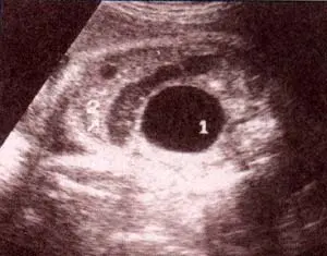 Abdomen Fetal, 35 semanas, vejiga, colon