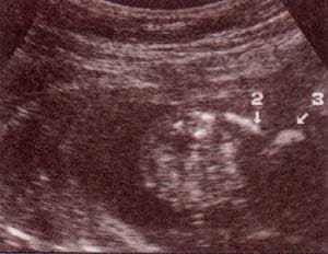 Diagnóstico Prenatal -  20 semanas. corte bajo lumbar