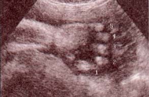 Diagnóstico Prenatal - aspectos normales en diferentes edades gestacionales