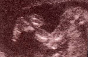 Diagnóstico Prenatal - aspectos normales de piernas y pies