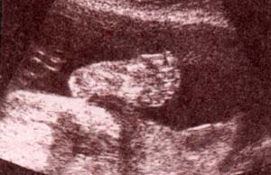 Diagnóstico Prenatal - 30 semanas. planta del pie