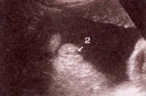 Diagnóstico Prenatal -  genitales externos xx
