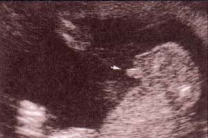 Diagnóstico Prenatal -  21 semanas. los testículos aún no descendidos