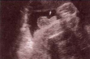 Diagnóstico Prenatal -  30 semanas. los testículos dentro del escroto