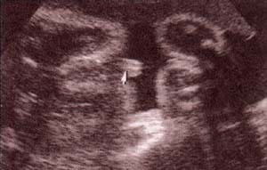 Diagnóstico Prenatal -  36 semanas. corte sagital. se observa el canal uretral.