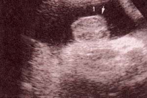 Diagnóstico Prenatal -  30 semanas. se observan los testículos