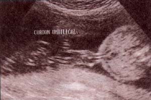Diagnóstico Prenatal -  diferentes cortes. 18 semanas