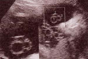 Diagnóstico Prenatal -  28 semanas. corte transversal