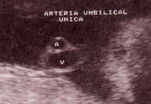 Diagnóstico Prenatal -  30 semanas. corte transversal de cordón umbilical