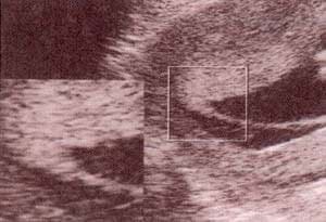 Diagnóstico Prenatal -  gemelar bicorial – biamniótico
