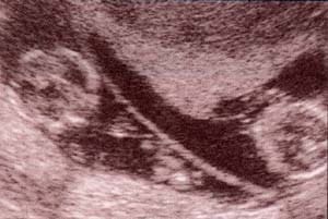 Diagnóstico Prenatal -  polos cefálicos .