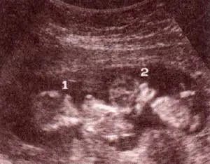 Diagnóstico Prenatal -  .gemelar monocorial - monoamniótico