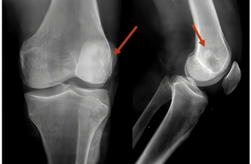 Fracturas del Cóndilo
