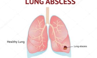 Absceso pulmonar