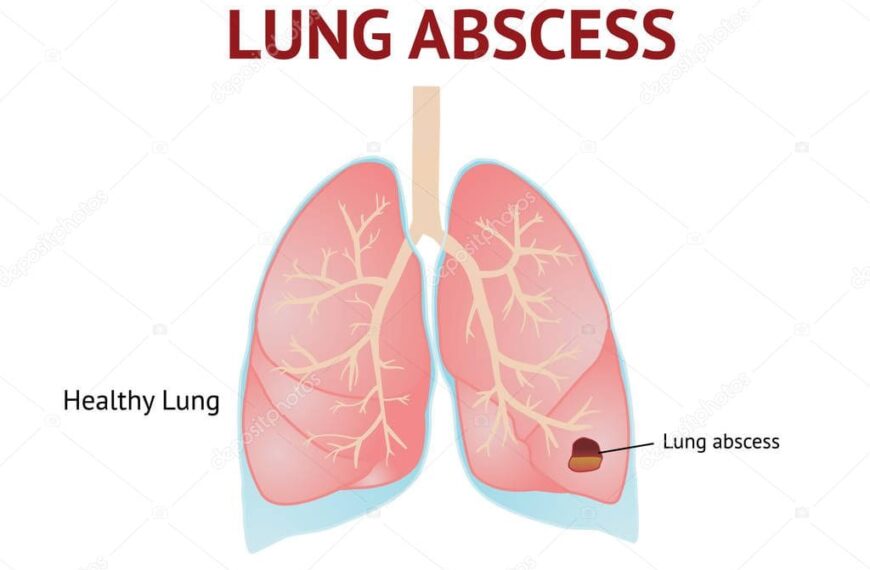 Absceso pulmonar