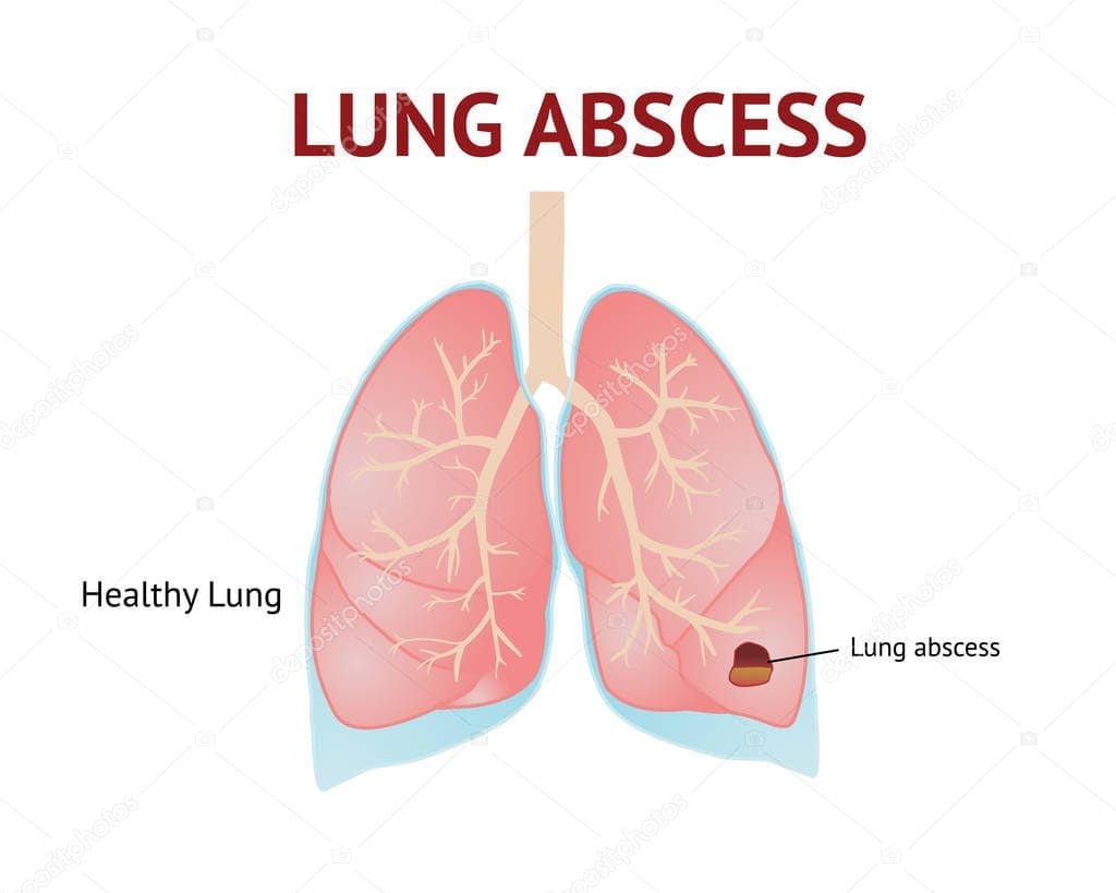 Absceso pulmonar