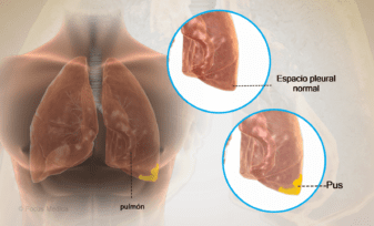 Empiema pleural