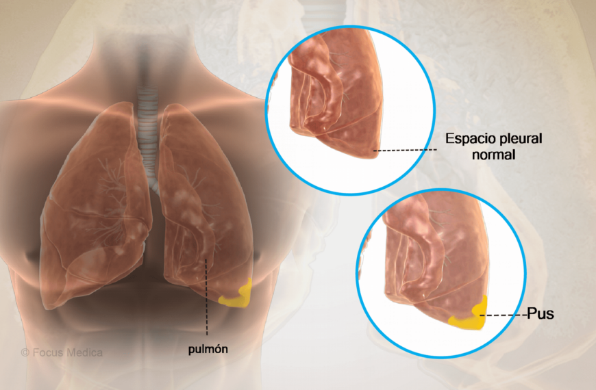 Empiema pleural