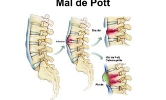 Mal de Pott