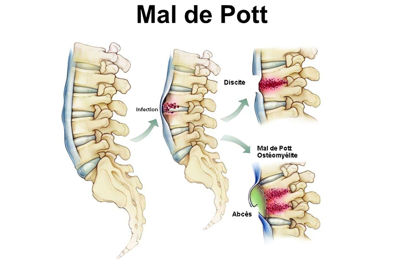 Mal de Pott