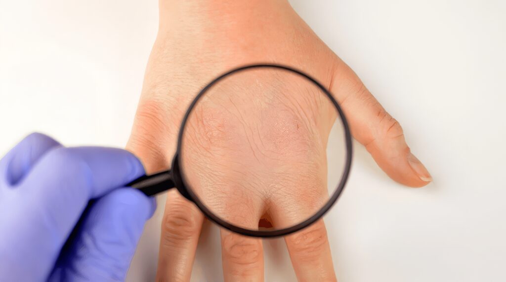 Dermatitis Atópica - Eczema