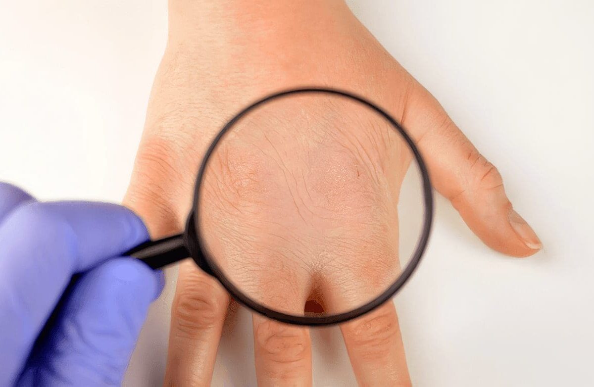 Dermatitis Atópica - Eczema