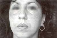 Paciente de 30 años con cuadro clínico de eczema en cara, por sulfato de níquel
