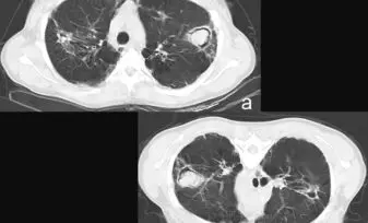 Aspergiloma