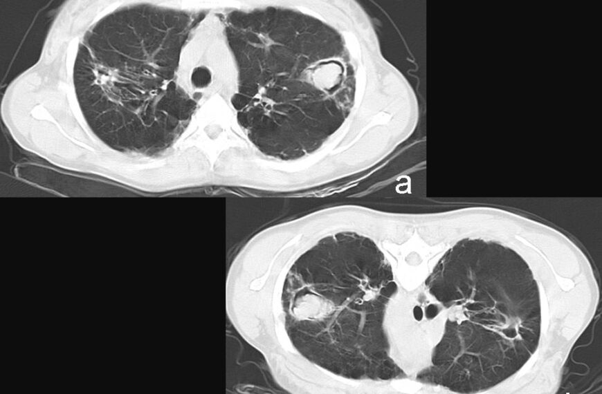 Aspergiloma