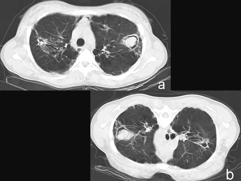 Aspergiloma