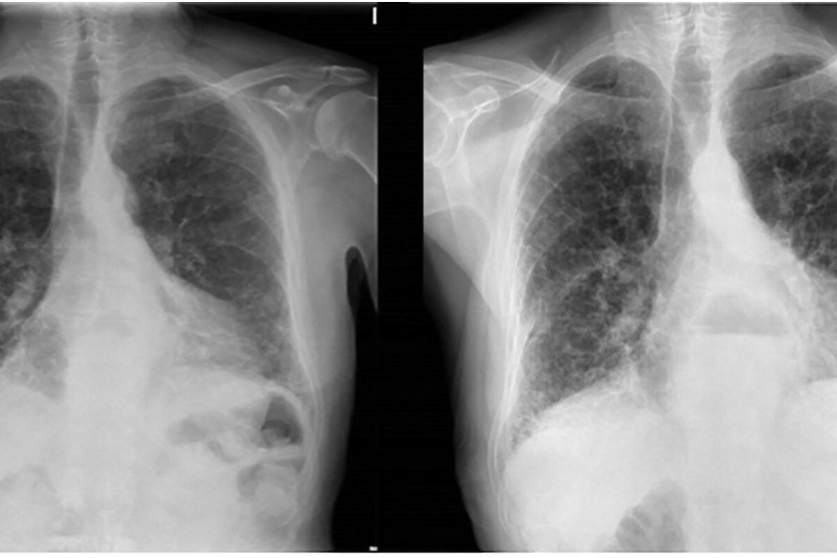 Decaimiento e infiltrado pulmonar