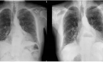 Decaimiento e infiltrado pulmonar