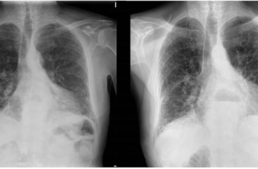 Decaimiento e infiltrado pulmonar