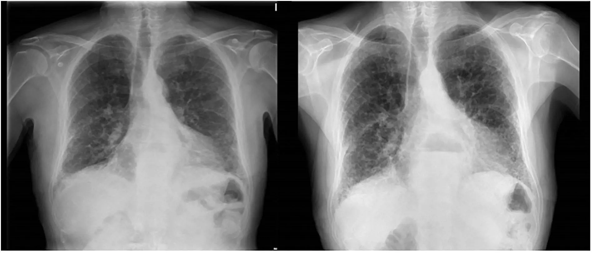 Decaimiento e infiltrado pulmonar