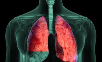 Derrame pleural neoplásico