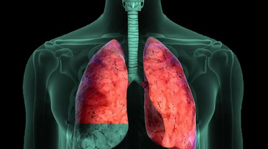 Derrame pleural neoplásico