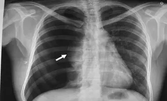 Espacio pleural, neumotórax, clasificaciones, diagnóstico, TAC