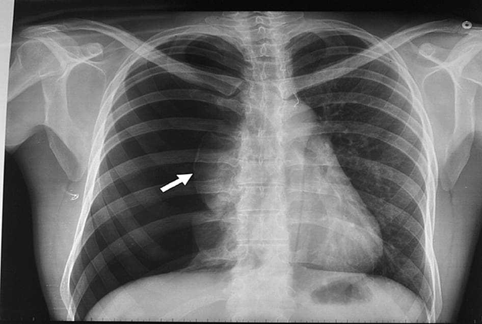 Espacio pleural, neumotórax, clasificaciones, diagnóstico, TAC