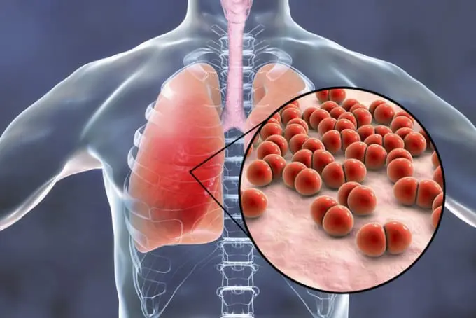 Neumoconiosis en Colombia