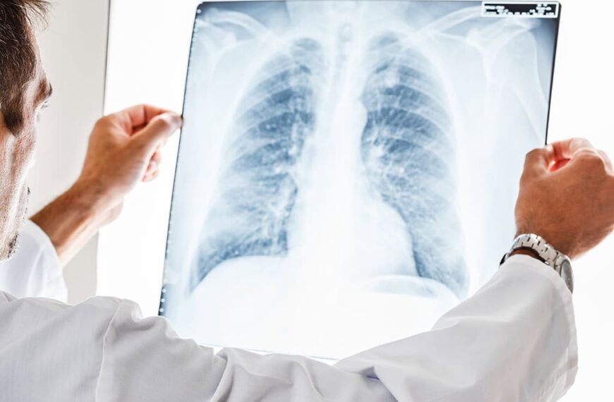 Nódulo pulmonar