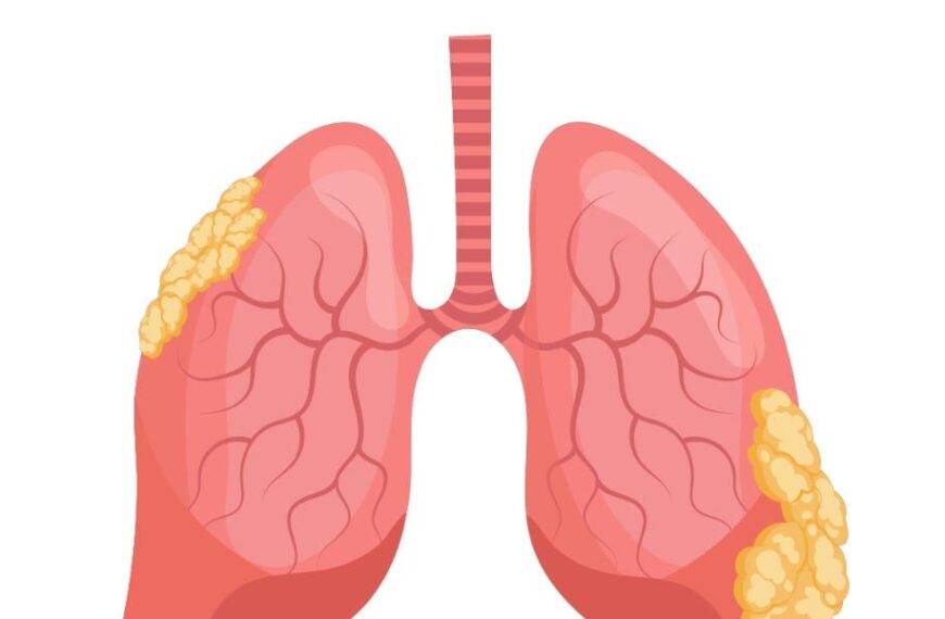 Pleurodesis con talco en derrame pleural neoplásico