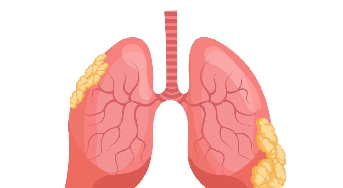 Pleurodesis con talco en derrame pleural neoplásico