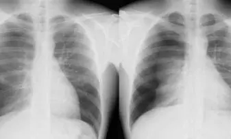 Radiografia de tórax en UCI