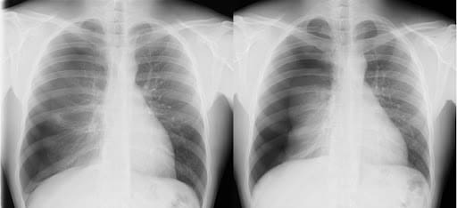 Radiografia de tórax en UCI