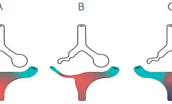 Vasoconstricción pulmonar hipóica