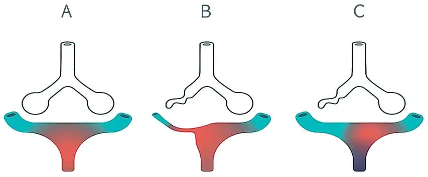 Vasoconstricción pulmonar hipóica