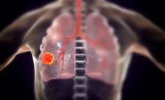 Sistema de estadificación del cáncer pulmonar TNM, Cáncer pulmonar de célula no pequeña