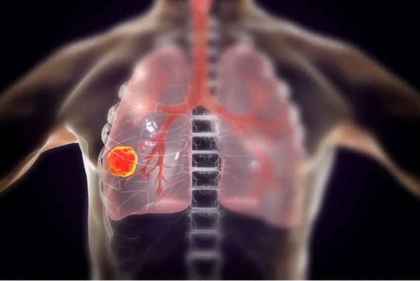 Sistema de estadificación del cáncer pulmonar TNM, Cáncer pulmonar de célula no pequeña